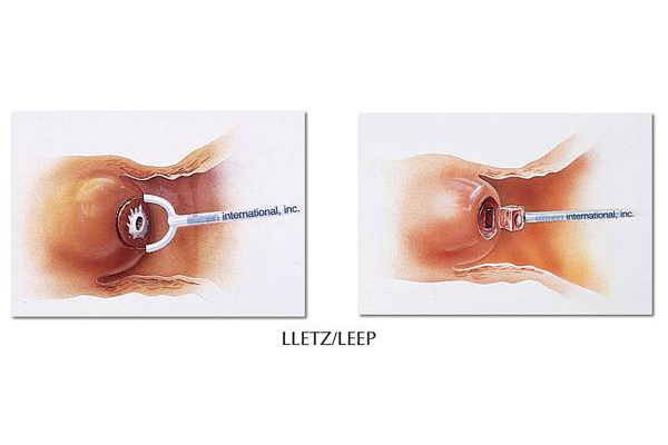 揭秘LEEP刀手術價格,科技前沿革新之旅體驗!