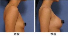 胸部抽脂手術價格探秘,小巷深處的美麗秘密及其費用解析